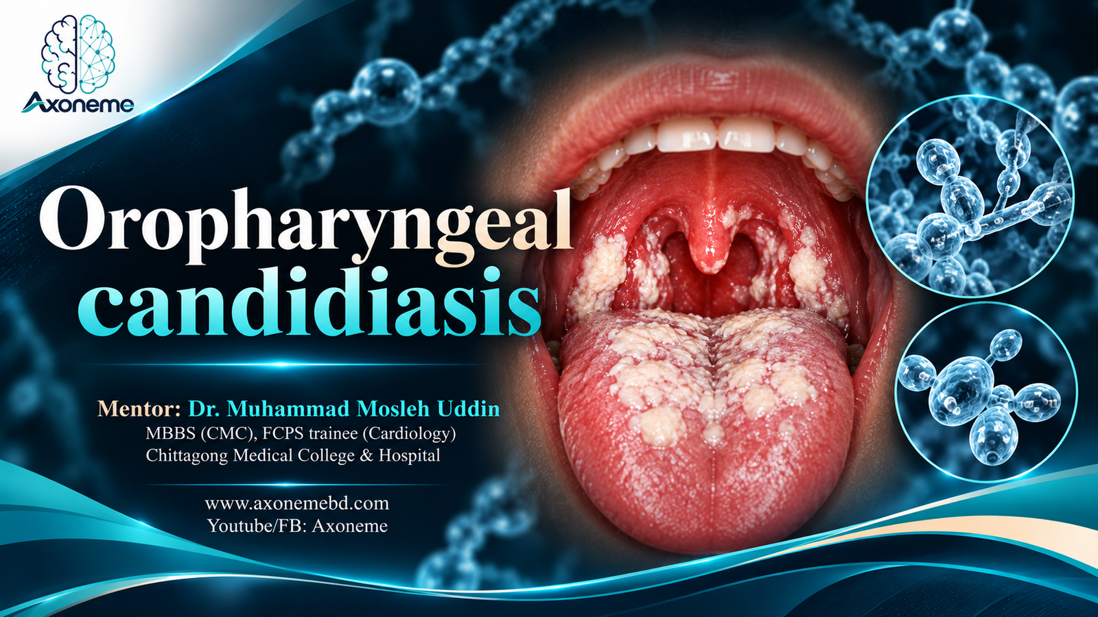 Oropharyngeal candidiasis